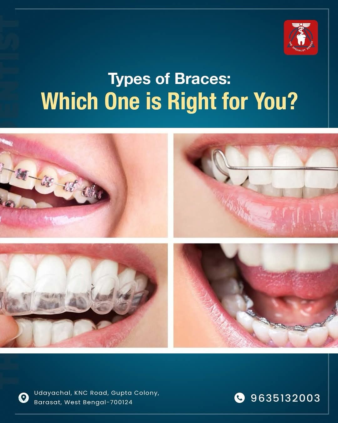 Braces vs Clear Aligners: Which One Should You Choose? | The Specialist ...